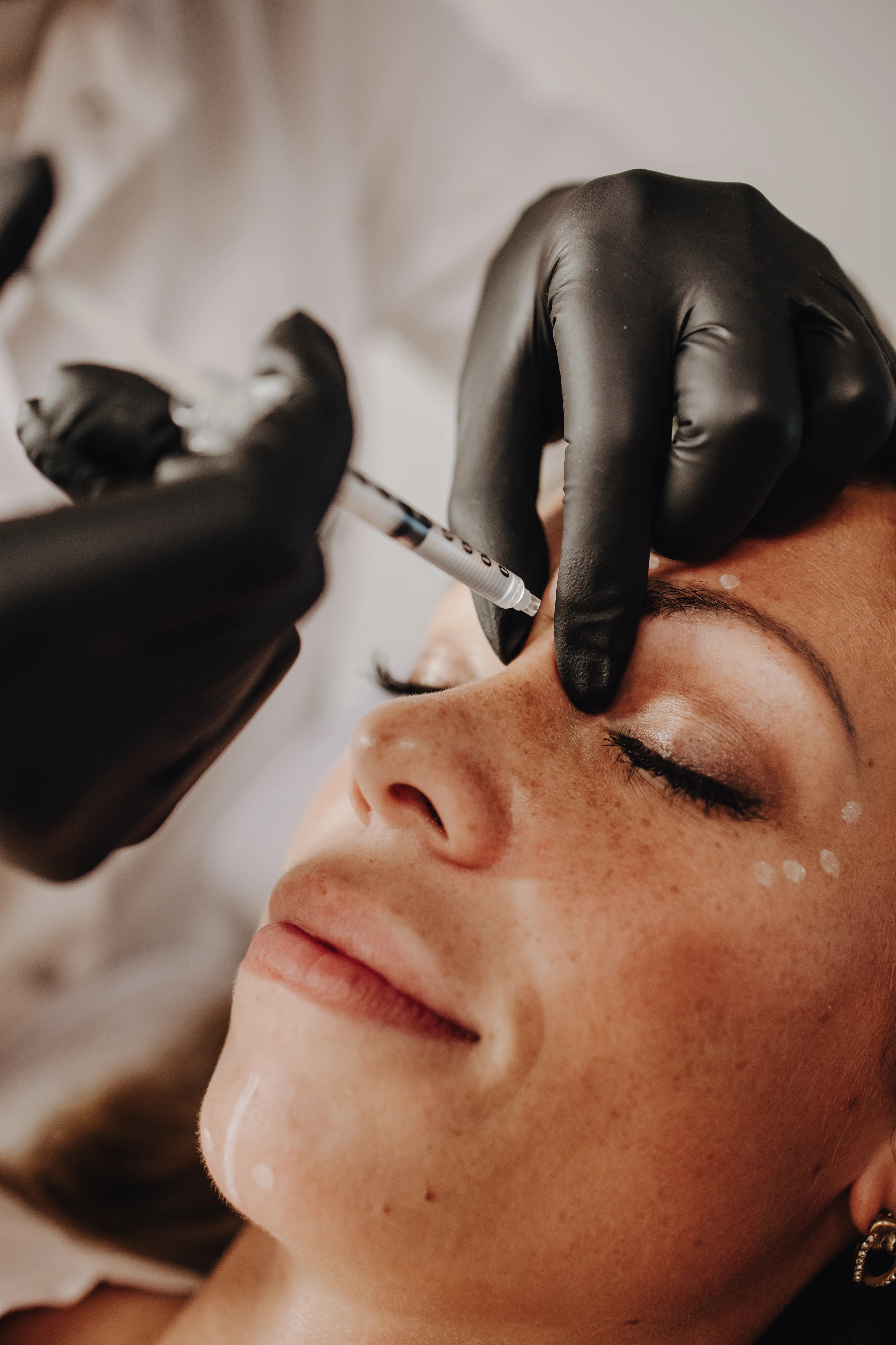 Fillers Oplossen bij Noveve Aesthetics