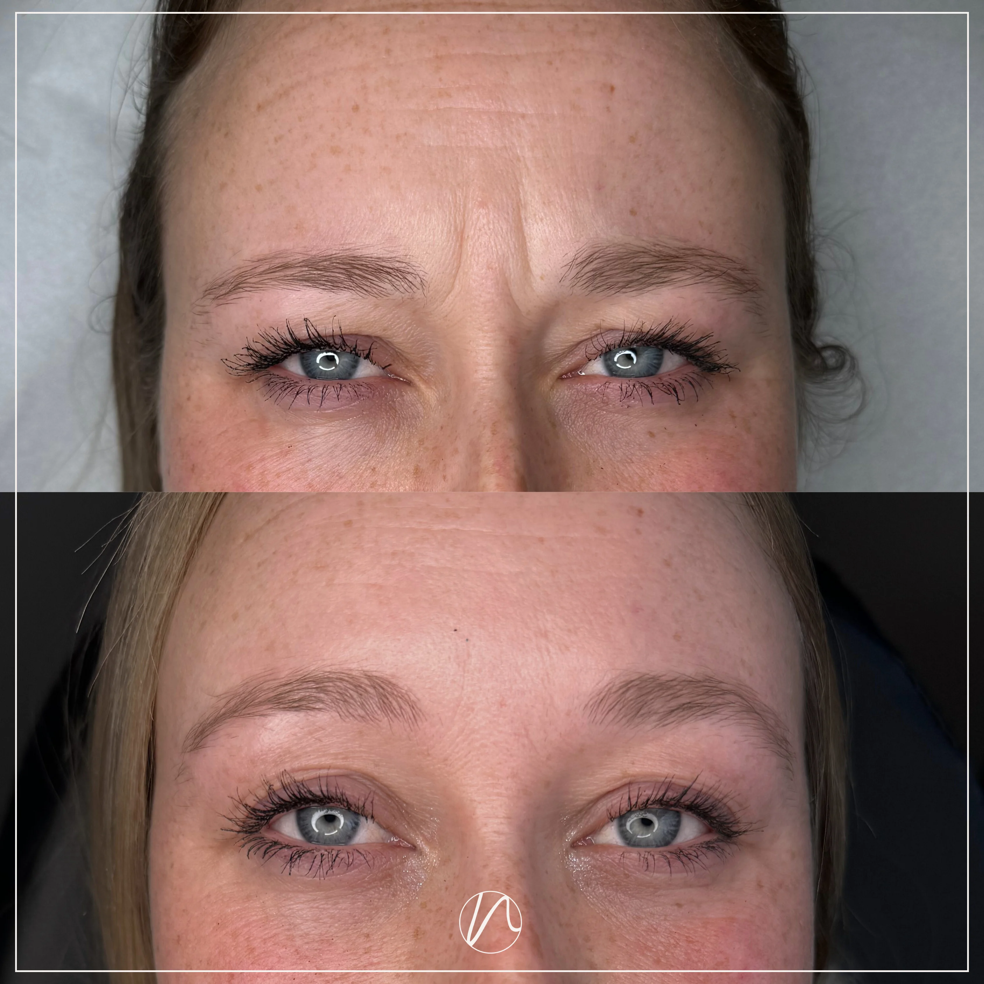 Botox frons resultaat 1 - voor en na