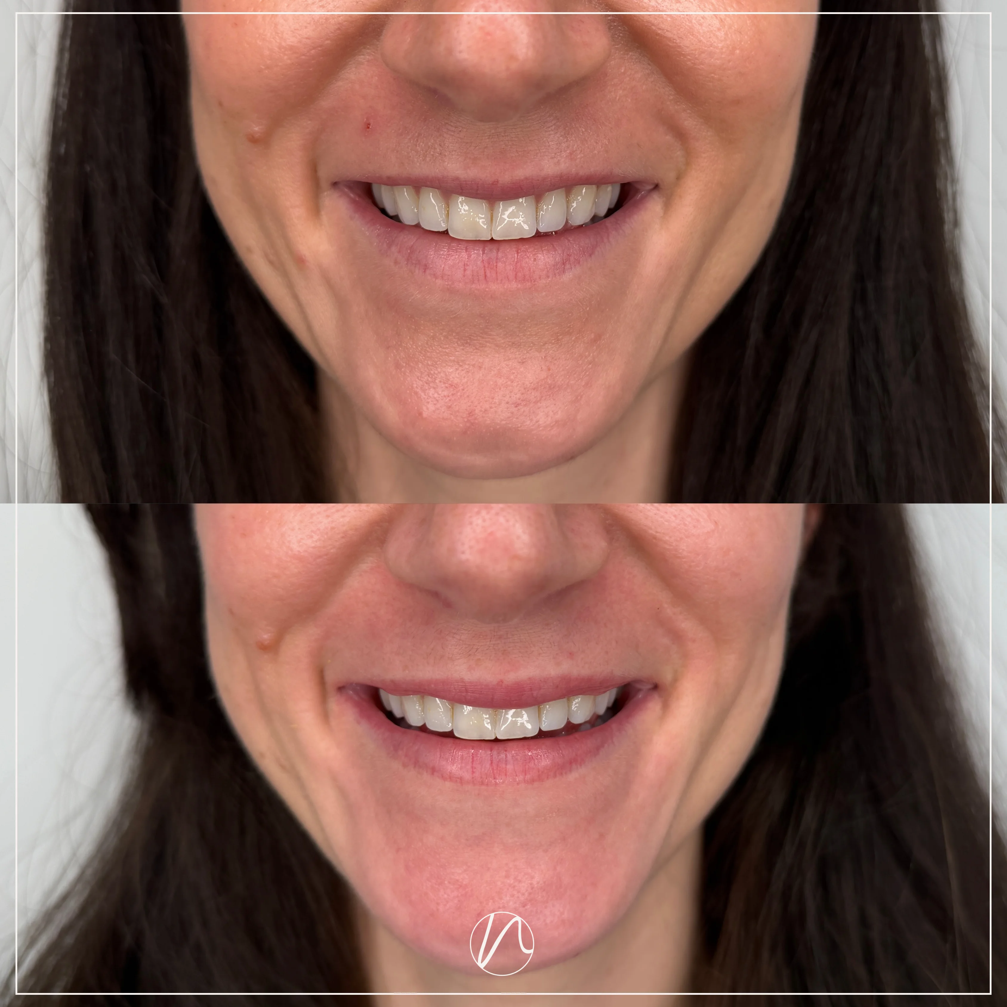 Resultaat lip flip met botox voor en na bij Noveve Aesthetics