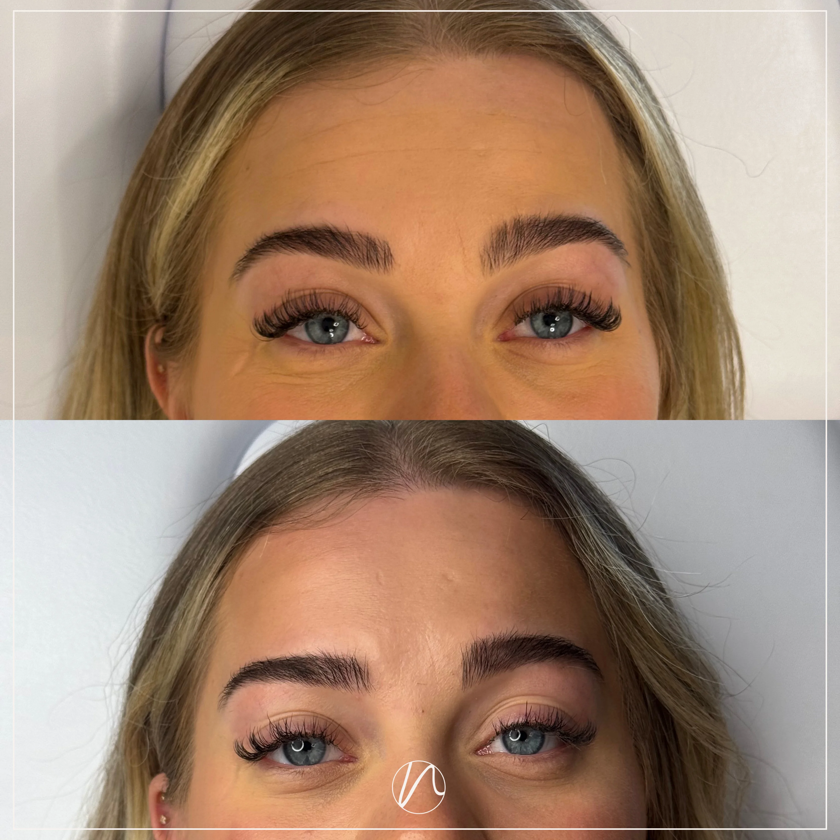 Botox voorhoofd resultaat - voor en na