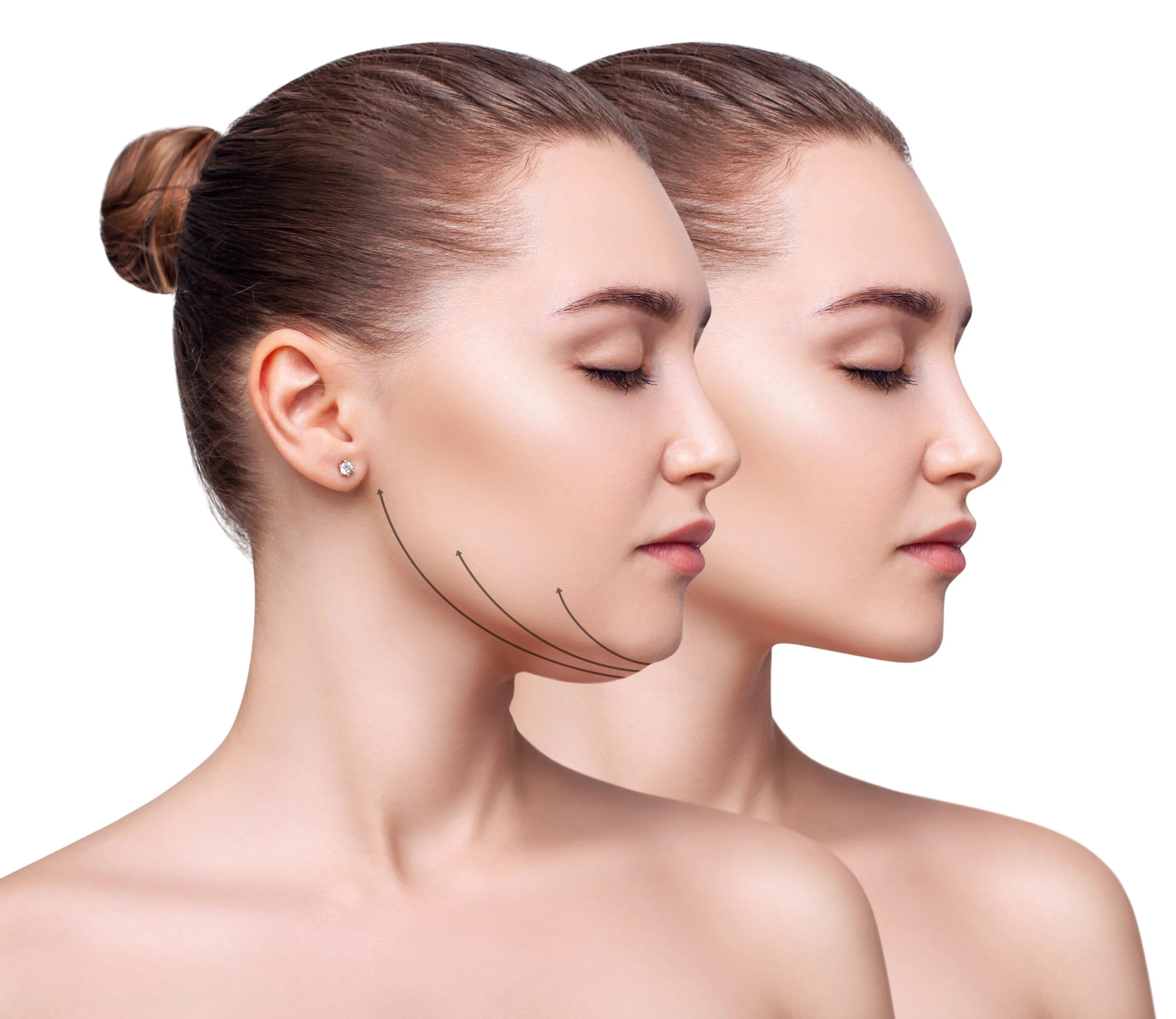Botox Face Slimming / Tandenknarsen bij Noveve Aesthetics