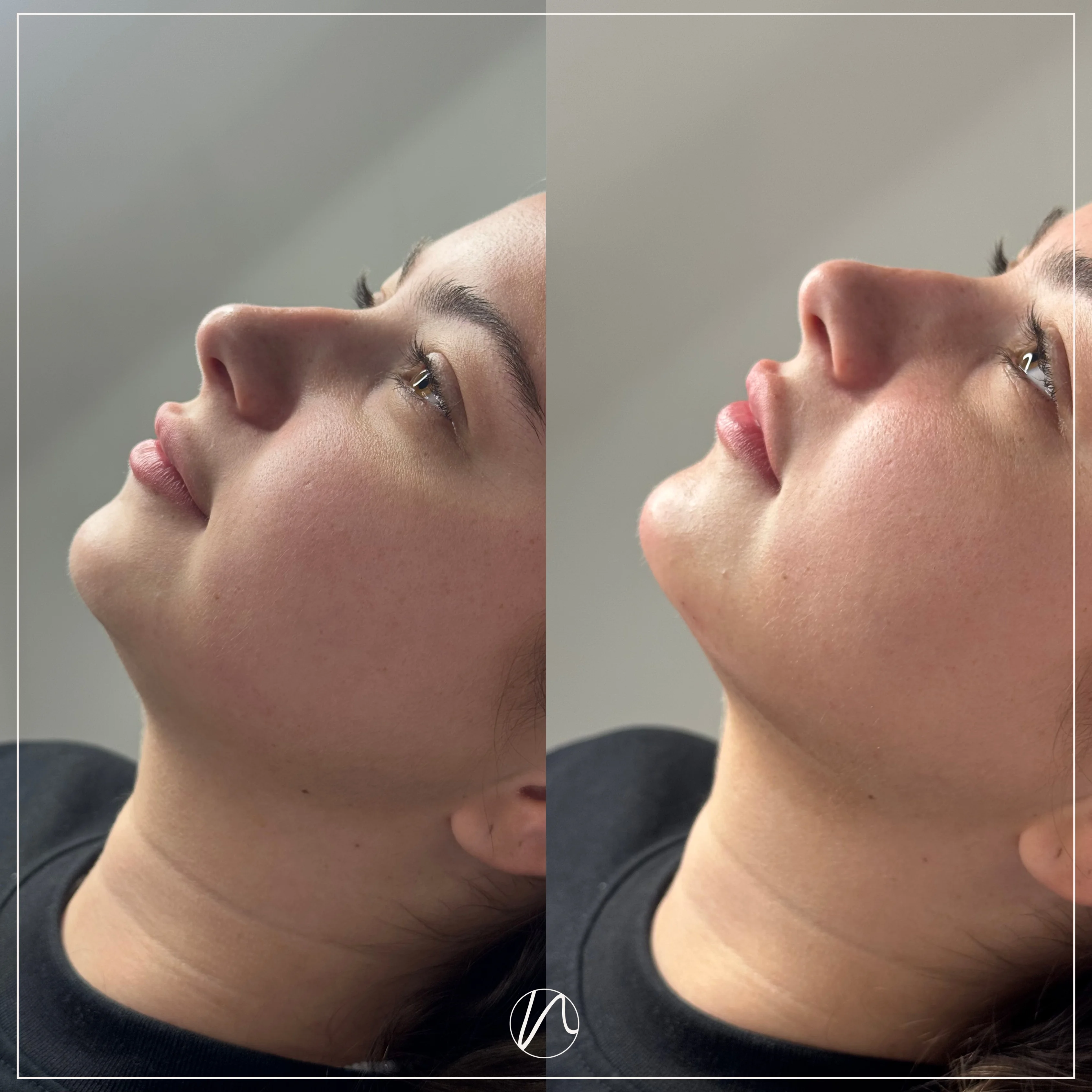 Kinfiller resultaat 1 - voor en na