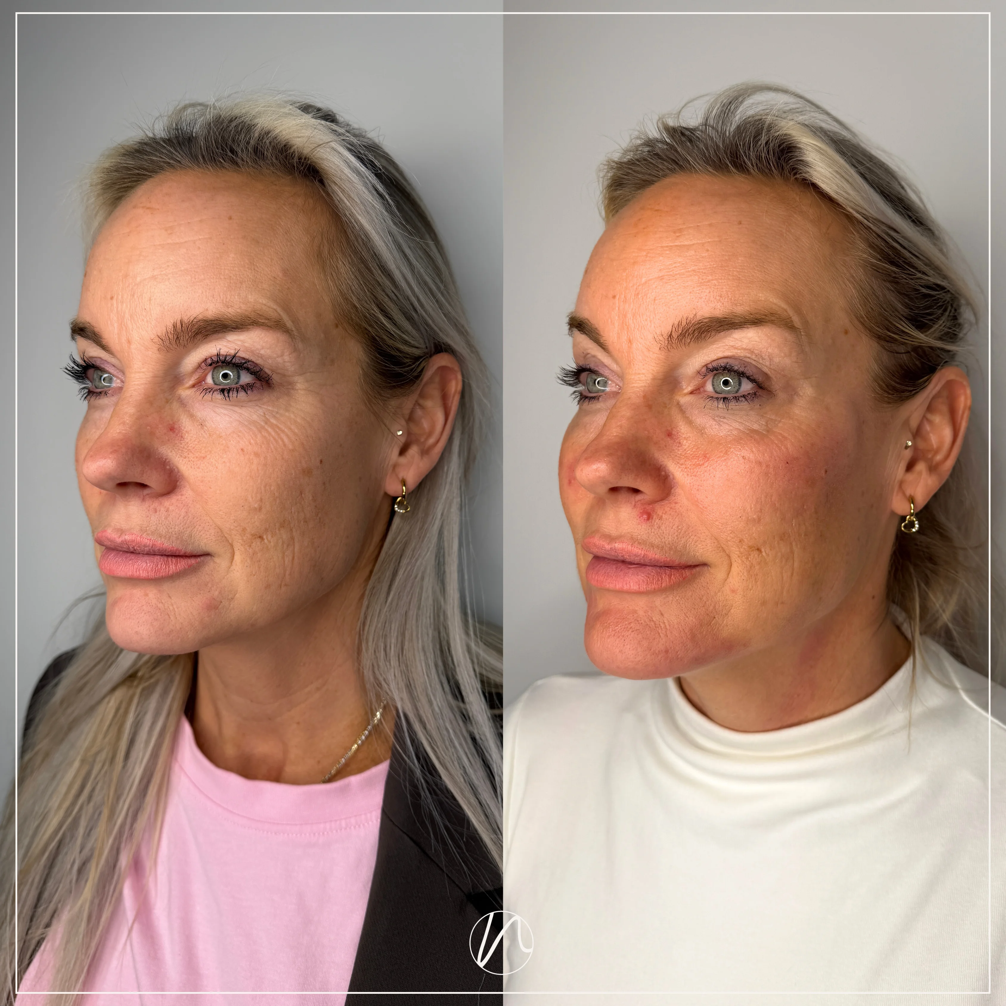 Kinfiller resultaat 2 - voor en na