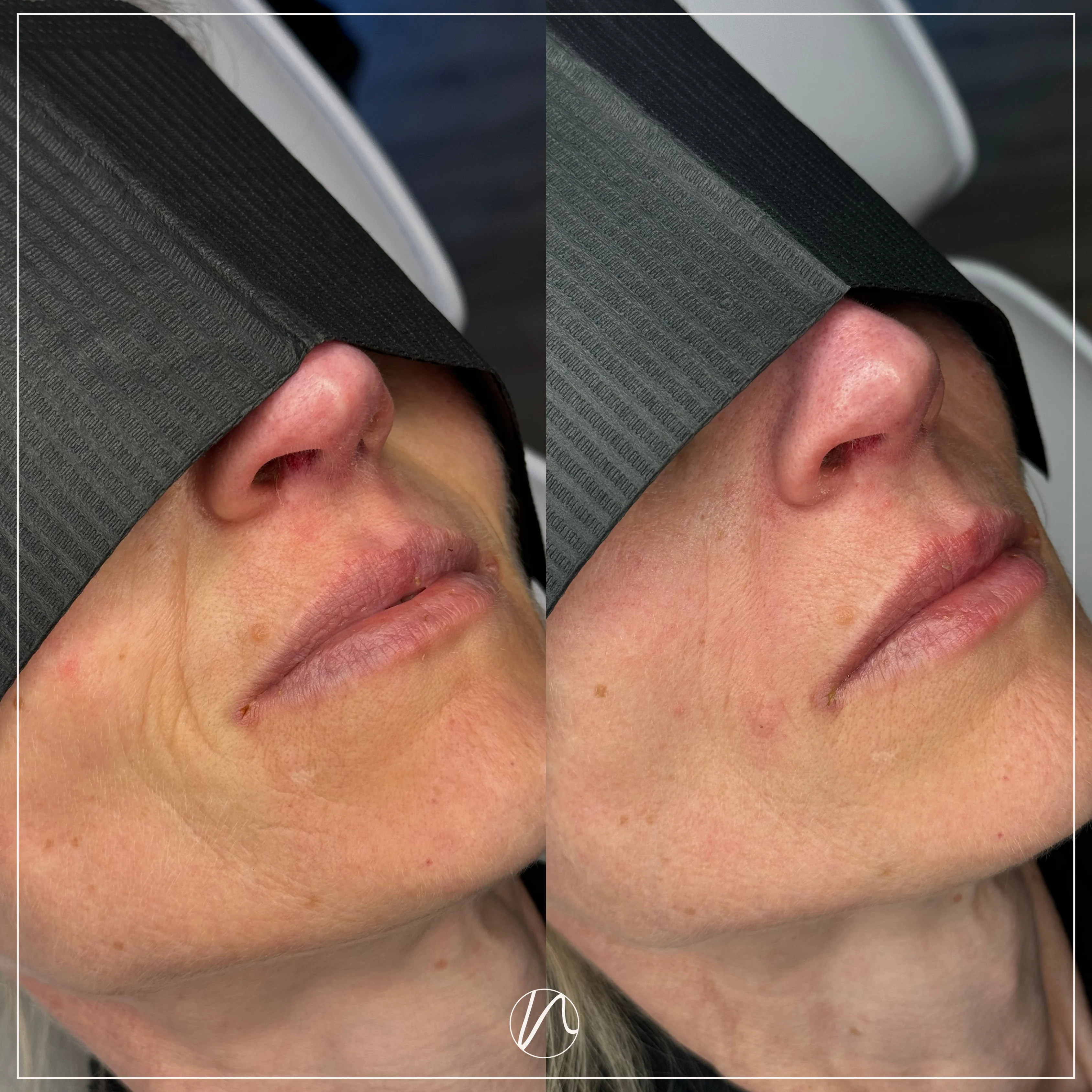 Resultaat neus-lippenplooi filler - voor en na