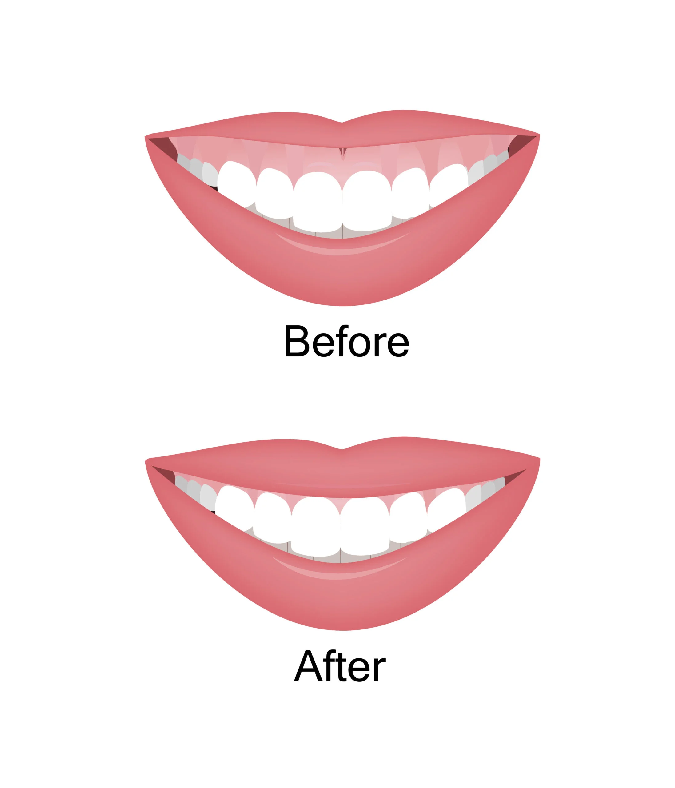 Botox Gummy Smile bij Noveve Aesthetics