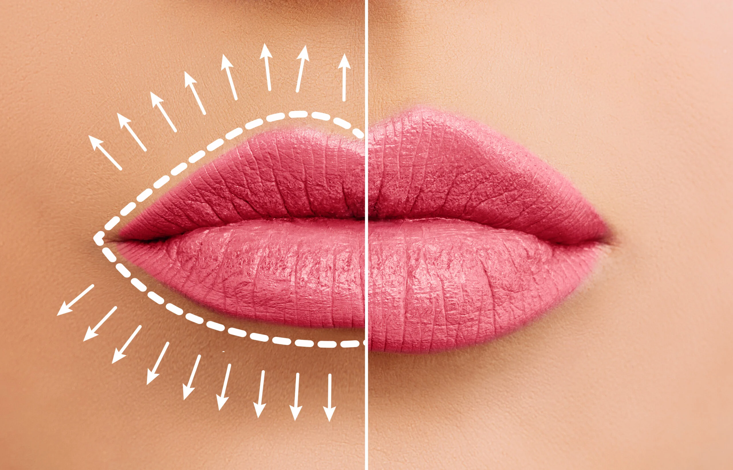 Russian Technique lipfiller bij Noveve Aesthetics
