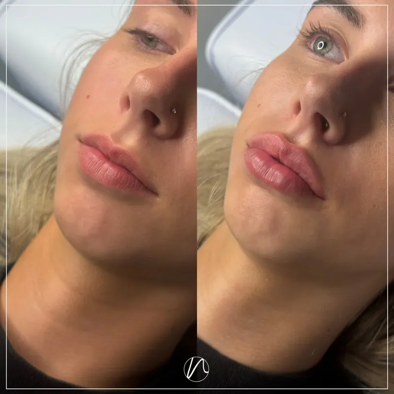 Lipfiller 1.0ml resultaat 1