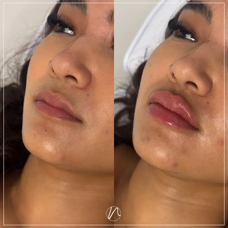 Lipfiller 1.0ml resultaat 2