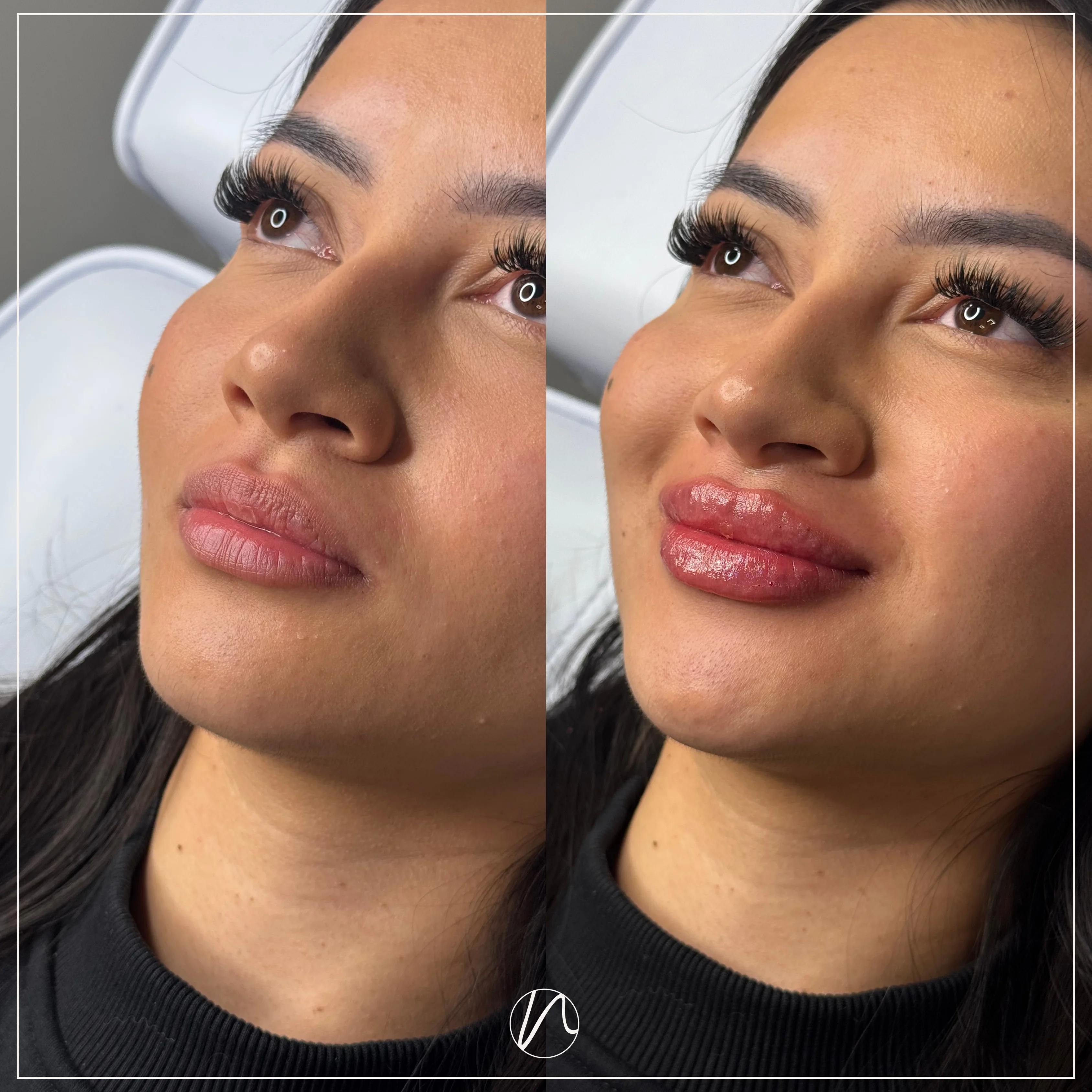 Lipfiller 1.0ml resultaat 3