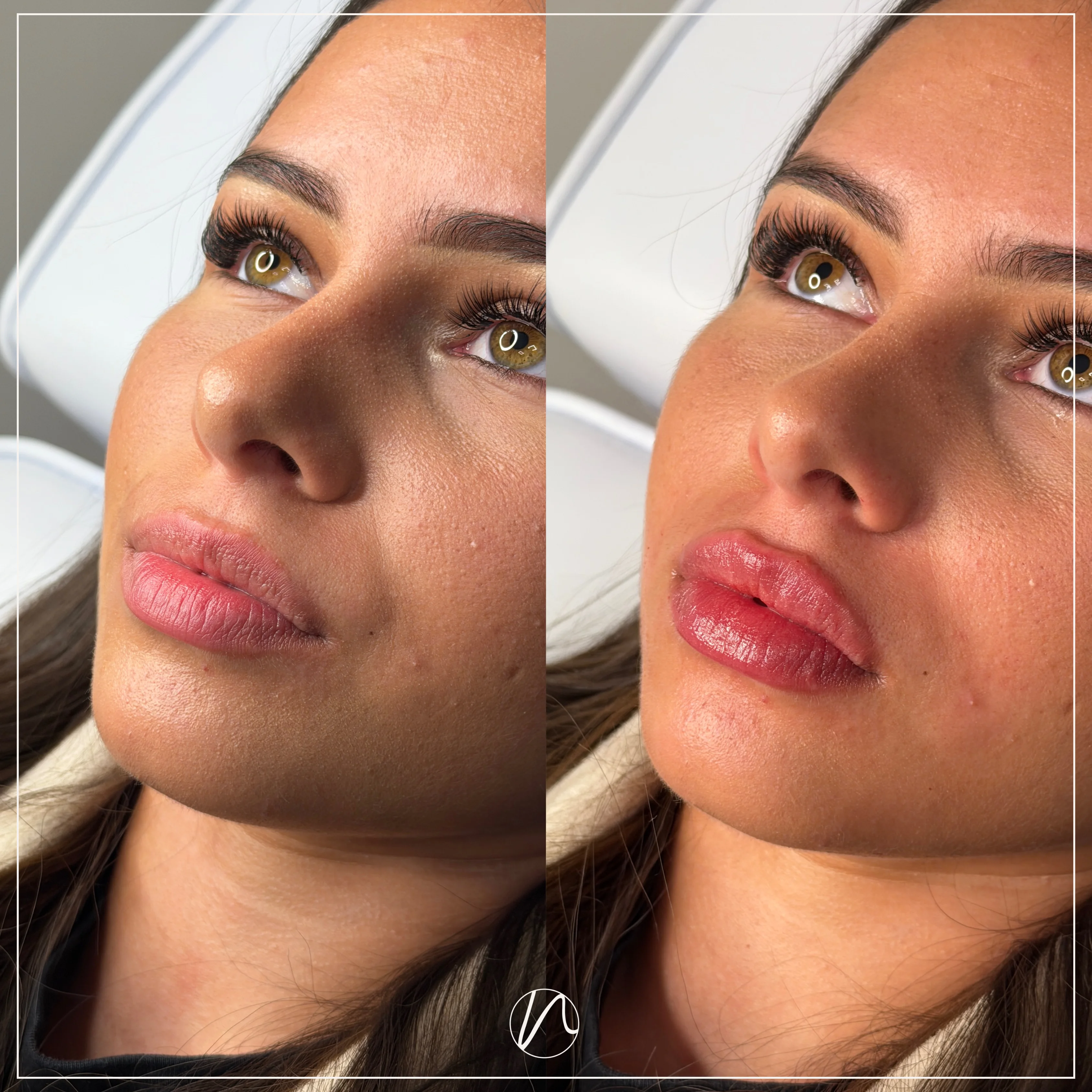 Lipfiller 1.0ml resultaat 4