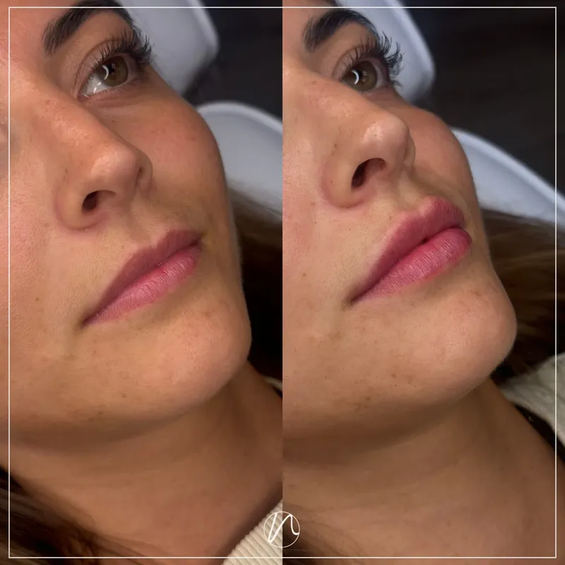 Lipfiller resultaat na 2 weken herstel