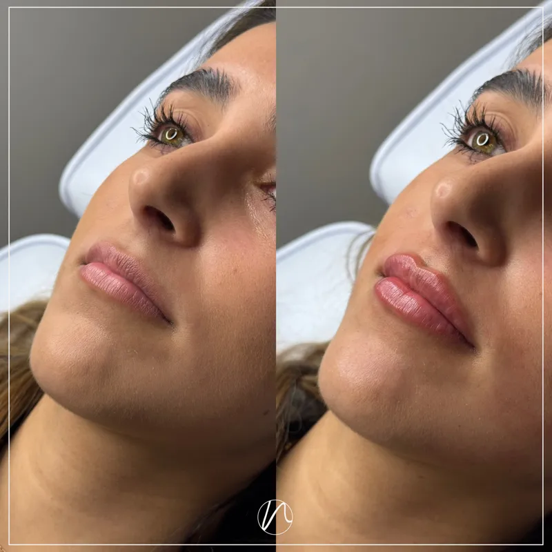Lipfiller 0.5ml resultaat 1