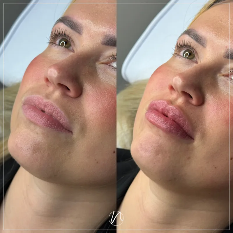 Lipfiller 0.5ml resultaat 3