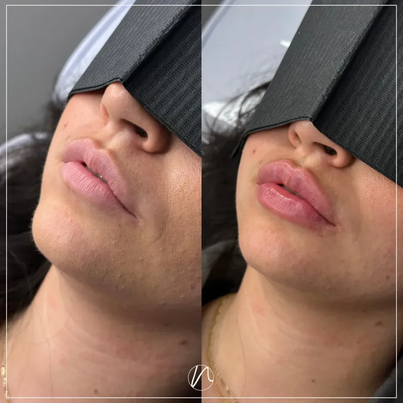 Lipfiller 0.5ml resultaat 4