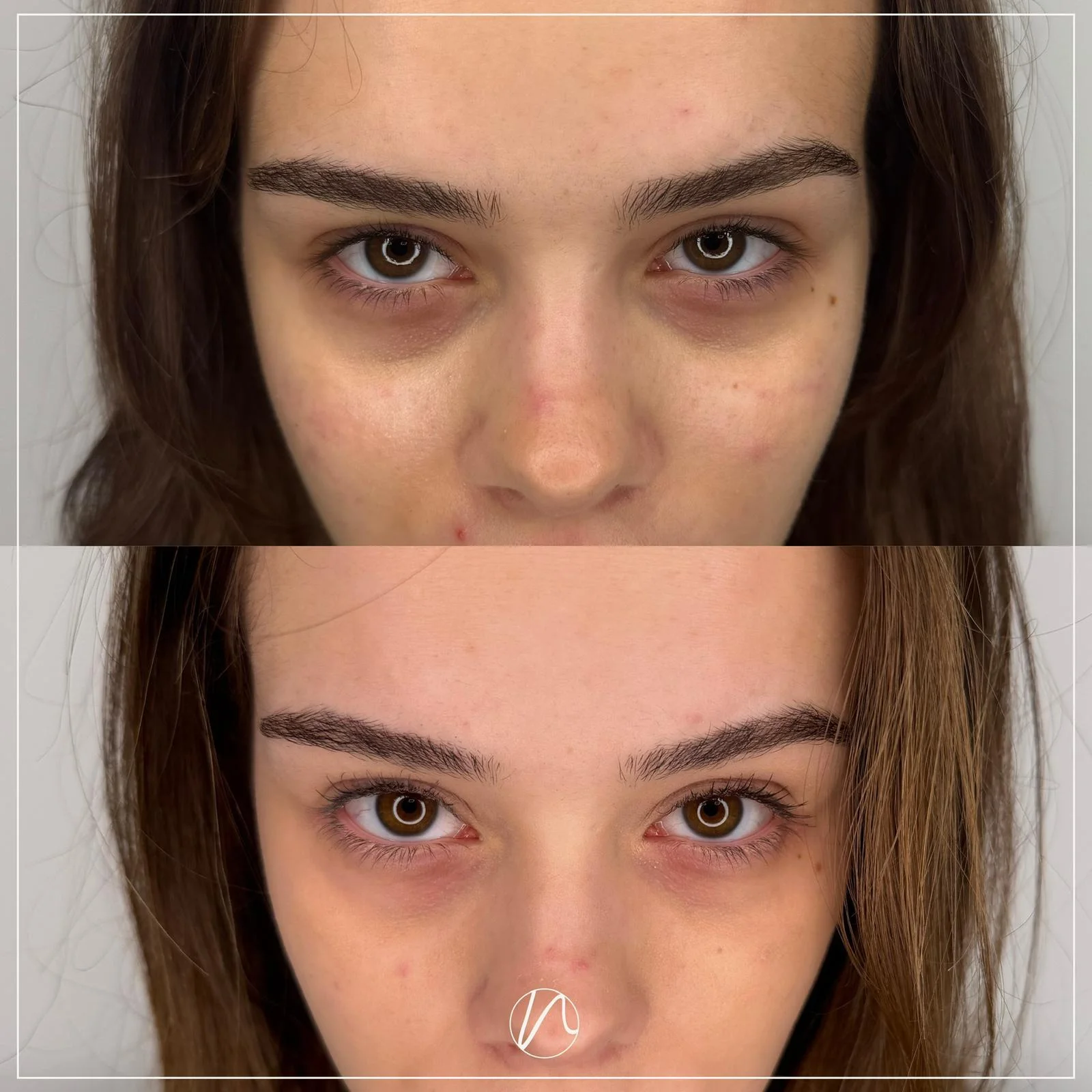 Resultaat Ami Eyes polynucleotide behandeling bij Noveve Aesthetics