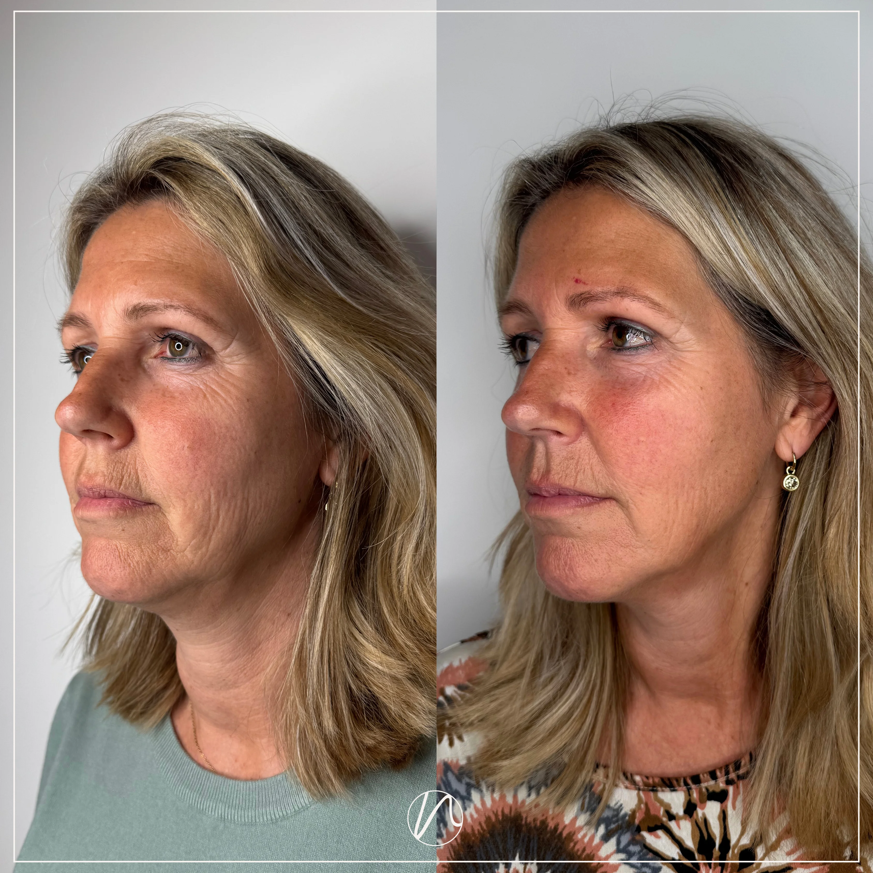 Resultaat Sunekos behandeling 1