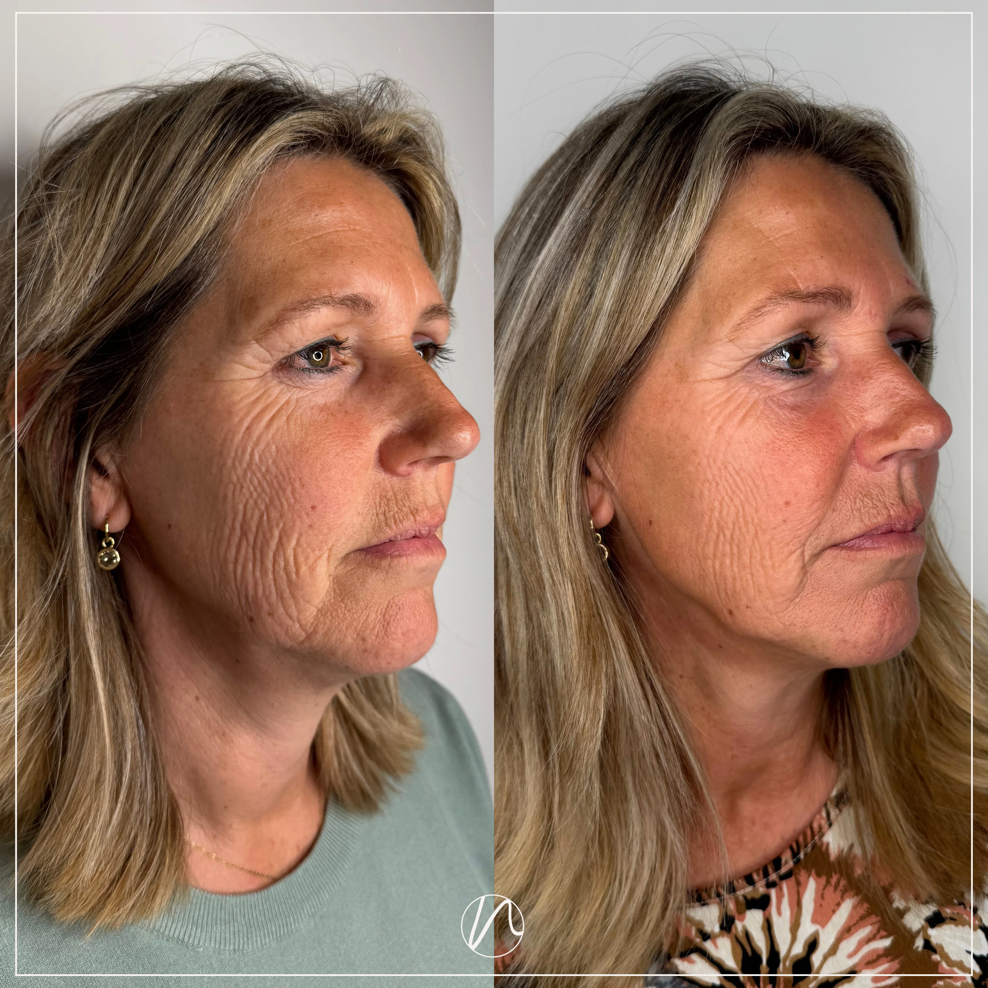 Resultaat Sunekos behandeling 2