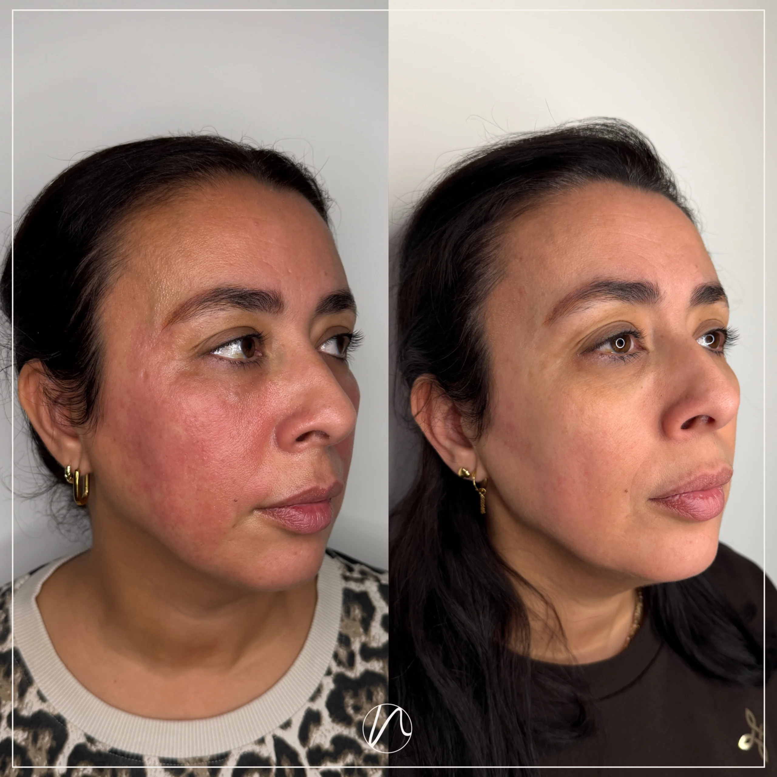 Resultaat Sunekos behandeling 3